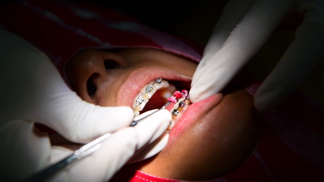 牙科诊所里戴着牙套的女人视频素材