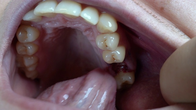 一名男子在拔牙后用舌头检查牙龈出血。失去臼齿。视频下载