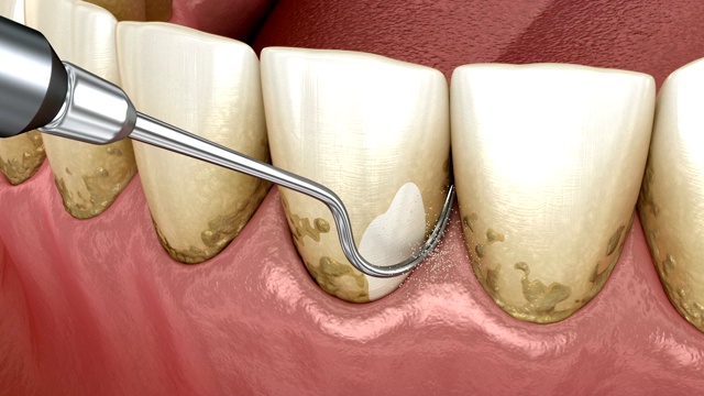 口腔卫生:刮治和根刨(常规牙周治疗)。医学上精确的人类牙齿治疗3D动画视频素材