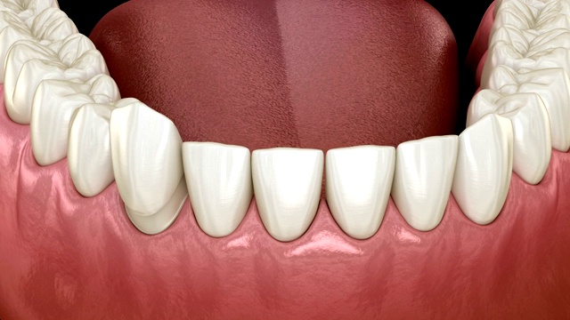 中切牙和侧切牙贴面安装程序。医学上准确的牙齿3D动画视频素材