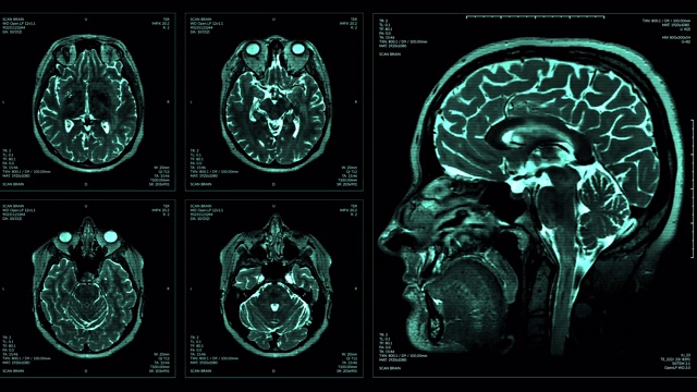 脑部MRT扫描显示视频素材