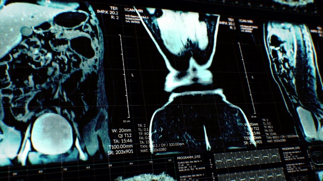 动画的用户界面HUD与身体分析和dna移动在黑暗的背景与谷物处理的未来概念视频素材