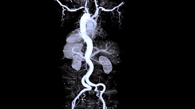 CTA全主动脉三维渲染图像在屏幕上显示主动脉夹层。视频素材