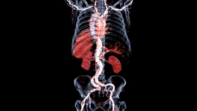 CTA全主动脉三维渲染图像与骨架在屏幕上透明旋转，检测主动脉夹层。视频素材