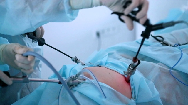 腹腔镜手术一个人腹腔内的腹腔镜手术视频下载
