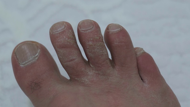 真菌和老茧形成在脚趾上，一个被忽视的人的脚，视频下载