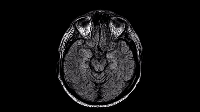 大量的MRI扫描大脑和头部来检测肿瘤。医疗诊断工具视频下载