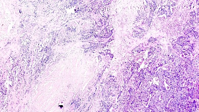 膀胱移行细胞癌不同部位显微镜变焦观察视频素材