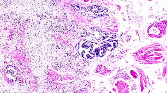 前列腺癌活检在显微镜放大下的不同区域视频素材