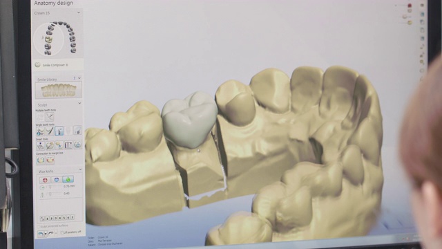 牙科实验室技术员在三维建模软件中设计种植体视频素材