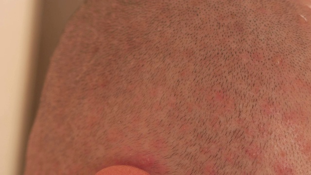 水痘带状疱疹病毒引起的水泡疹。一个男人脸上有水痘的特写视频素材