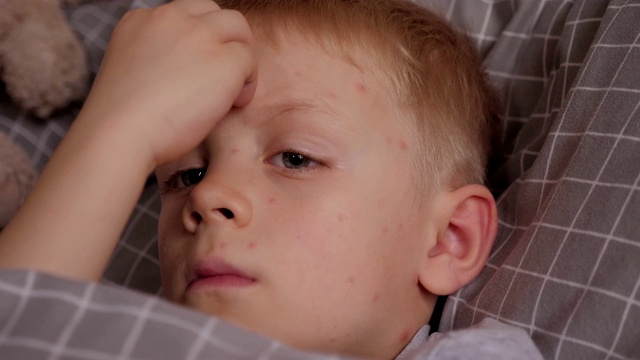 一个患水痘的小男孩躺在床上抓着脸上的皮肤视频下载