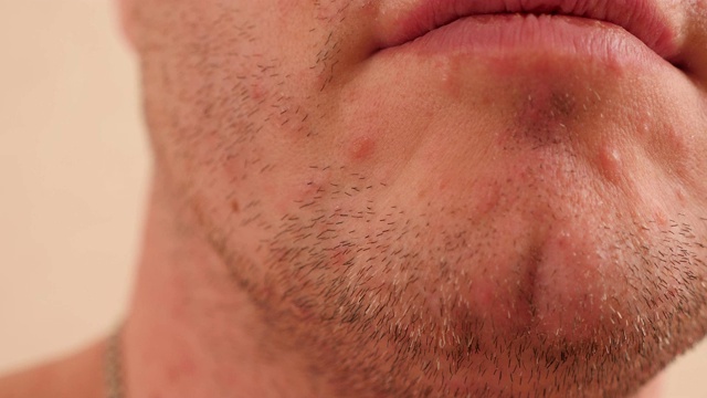 水痘带状疱疹病毒引起的水泡疹。一个男人脸上有水痘的特写视频素材