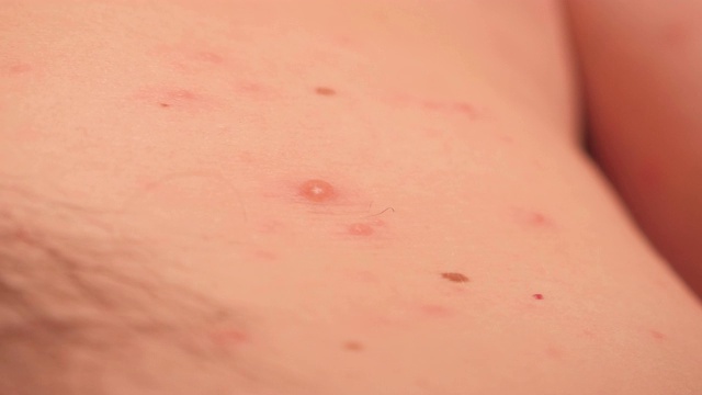 水痘患水痘或水痘的成年男子特写镜头。视频素材