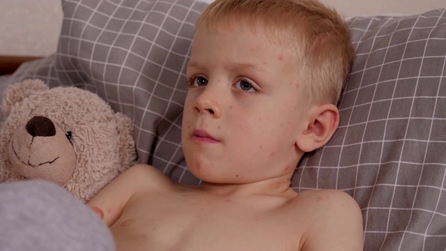 一个患水痘的小男孩正躺在床上吞药丸。视频下载