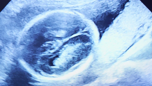 在超声波显示器上，人类胚胎正在轻微地移动他的头部视频素材