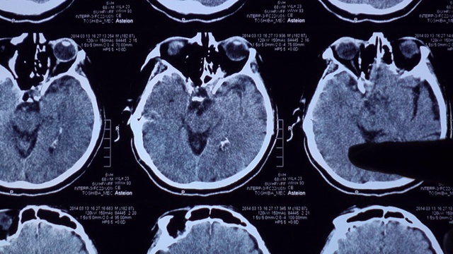 片剂脑MRI检查视频素材