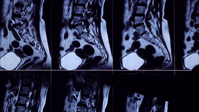 腰椎MRI检查片视频素材