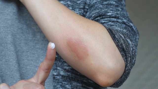 皮肤变态反应性疾病的问题，特应性皮炎皮疹的治疗近况，女性皮肤科患者的过敏性湿疹的手臂，银屑病复发由虚弱和不健康。视频素材
