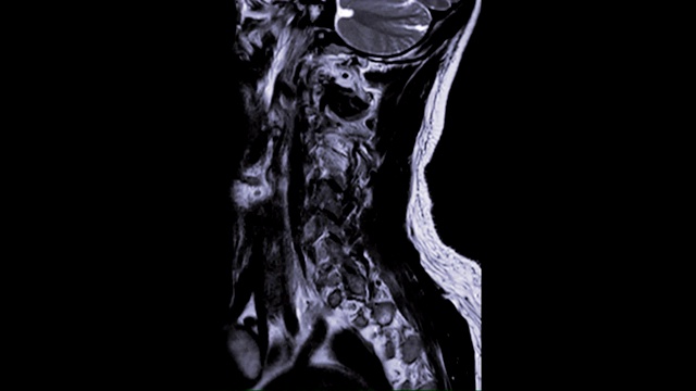 颈椎T2W矢状位MRI诊断C3、C4处脊髓受压。视频下载