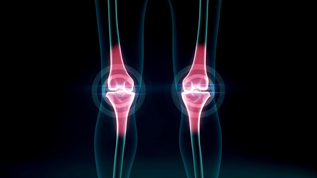 膝关节炎疼痛。健康的关节和不健康的伴有骨关节炎疼痛的关节。4 k.2。视频下载