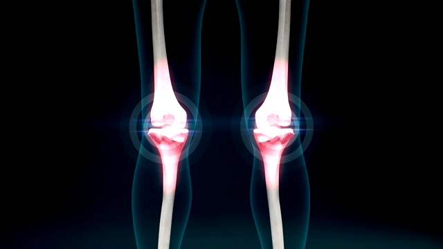 膝关节炎疼痛。健康的关节和不健康的伴有骨关节炎疼痛的关节。4 k.1。视频下载