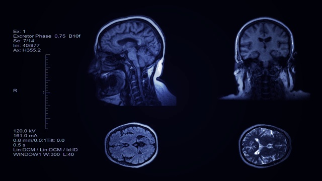 头部和脑部计算机断层扫描结果可视化。四分区幻灯片人的头部筛选。三维放射医学检查视频素材