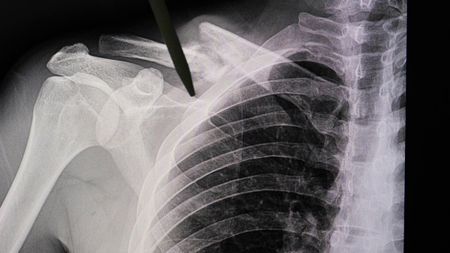 锁骨骨折的x光片。视频素材