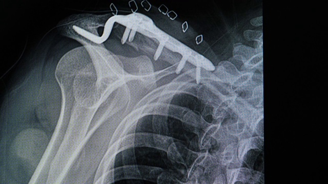 金属钢板和螺钉固定后锁骨骨折患者的x光片视频素材