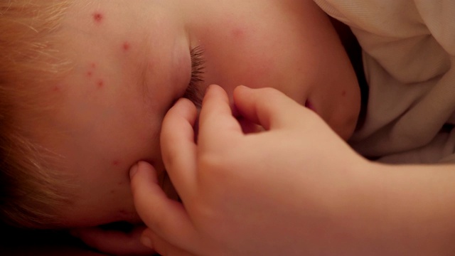 一个患了水痘的悲伤小男孩躺在家里的床上。视频下载