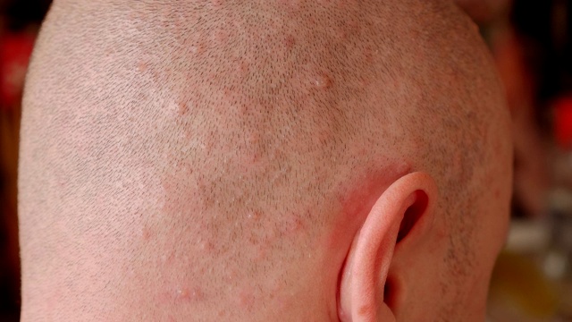 一个秃顶男人的头与水痘皮肤上的疹子的特写。视频素材