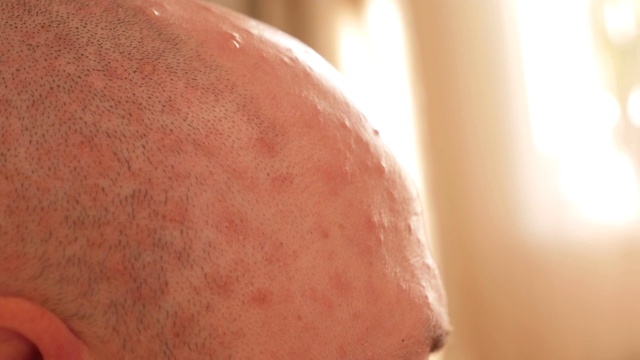 一个秃顶男人的头与水痘皮肤上的疹子的特写。视频素材