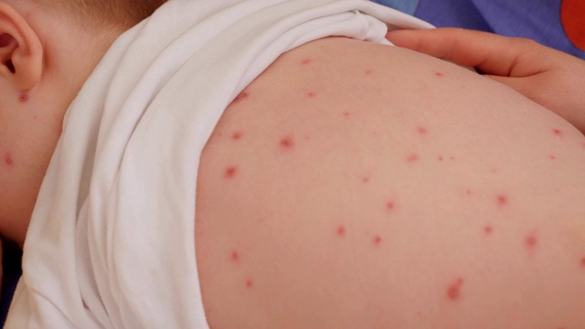 一个母亲检查一个患有水痘的孩子发炎的皮肤的特写。视频下载