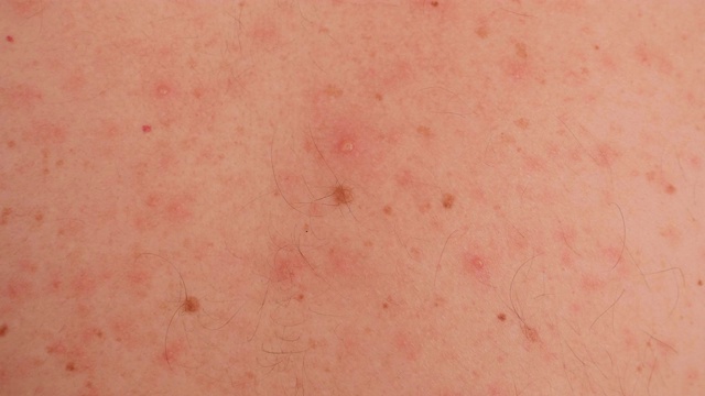一个成年男性皮肤上的大疹子或天花的特写。视频素材