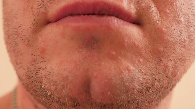 一个成年男性皮肤上的水痘的许多红疹的特写。视频下载
