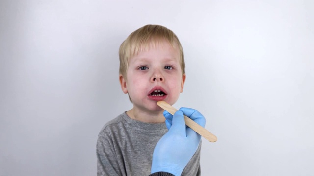 一位耳鼻喉科医生用一把木铲检查一个孩子的喉咙。一种可能的诊断是咽部炎症，扁桃体或咽炎。视频素材
