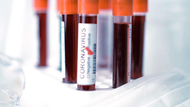 冠状病毒血液检测结果阳性和阴性视频素材