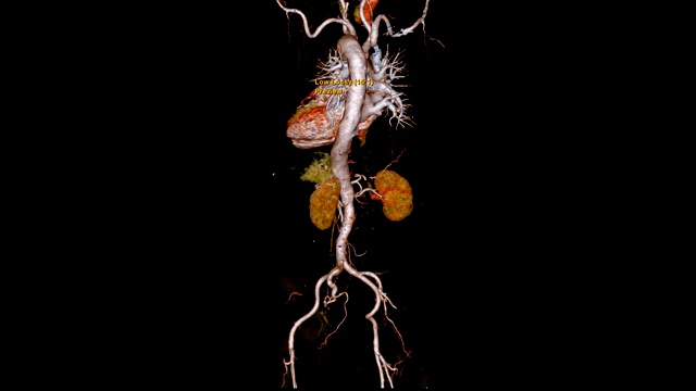 CTA全主动脉三维渲染图像在屏幕上旋转，用于检测动脉瘤。视频素材