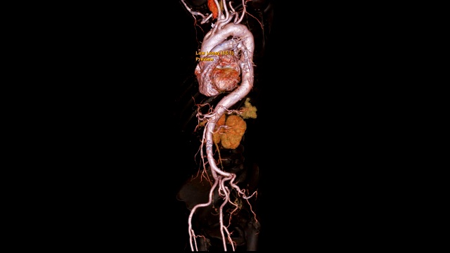 CTA全主动脉3D渲染图像，透明骨在屏幕上旋转，用于检测动脉瘤。视频素材