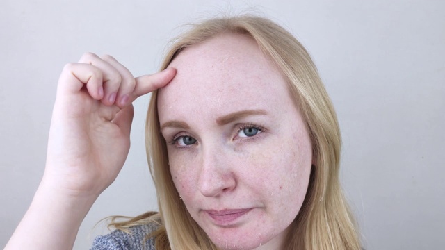 一位妇女在检查她脸上干燥的皮肤。脱皮、变粗、不适、皮肤敏感。患者可预约皮肤科医生或美容师，选择适合干燥的面霜视频素材