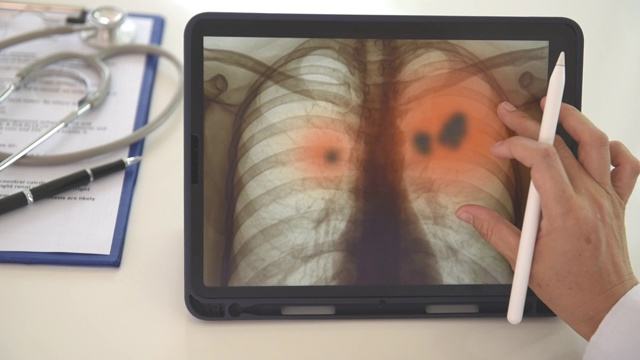 肺炎x线肺扫描视频素材