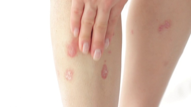 一名妇女使用消炎药治疗牛皮癣皮质类固醇。使用治疗软膏来缓解腿部的多发性炎。治疗皮肤病——牛皮癣、湿疹、皮炎、白癜风放射线视频素材