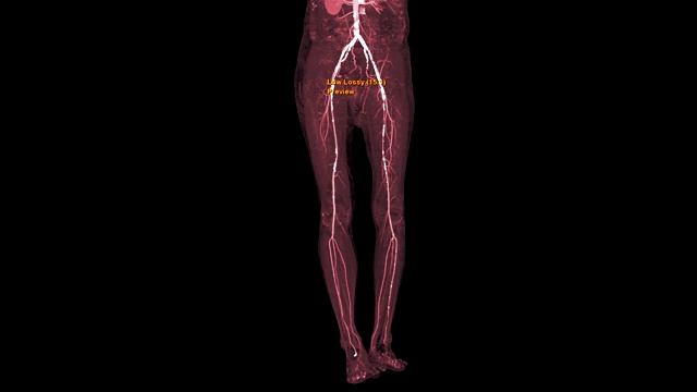 股动脉CTA三维MIP视图。视频下载