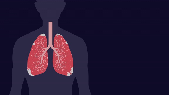 病毒或癌症在有拷贝空间的肺部发作视频下载