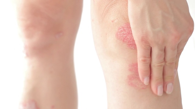 一名妇女使用消炎药治疗牛皮癣皮质类固醇。使用治疗软膏来缓解膝盖上的多发性炎。治疗皮肤病——牛皮癣、湿疹、皮炎视频素材