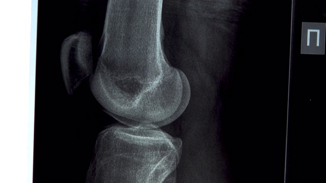 膝关节x线近照。从上到下的x射线图像视频下载