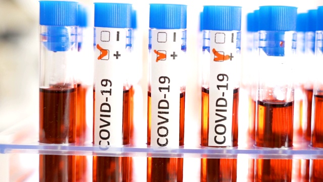 冠状病毒或Covid-19阳性检测试剂盒视频下载