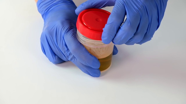 医生或实验室技术员打开装有尿液样本的容器，用于医学实验室、医学尿检和健康扫描分析和研究视频素材