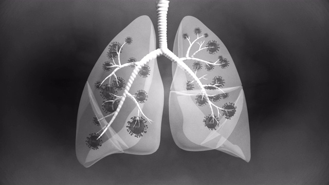 肺部疾病视图x射线- 4K分辨率视频素材