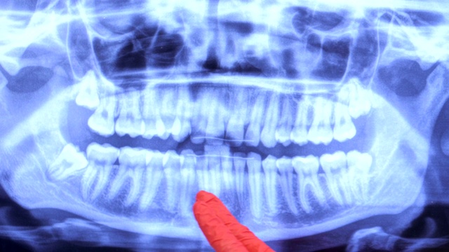 女牙医在监视器上显示病人的健康牙齿视频素材